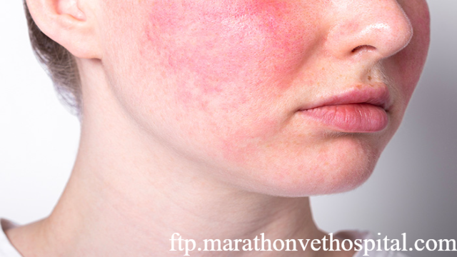 Metode Menghilangkan Kemerahan di Wajah